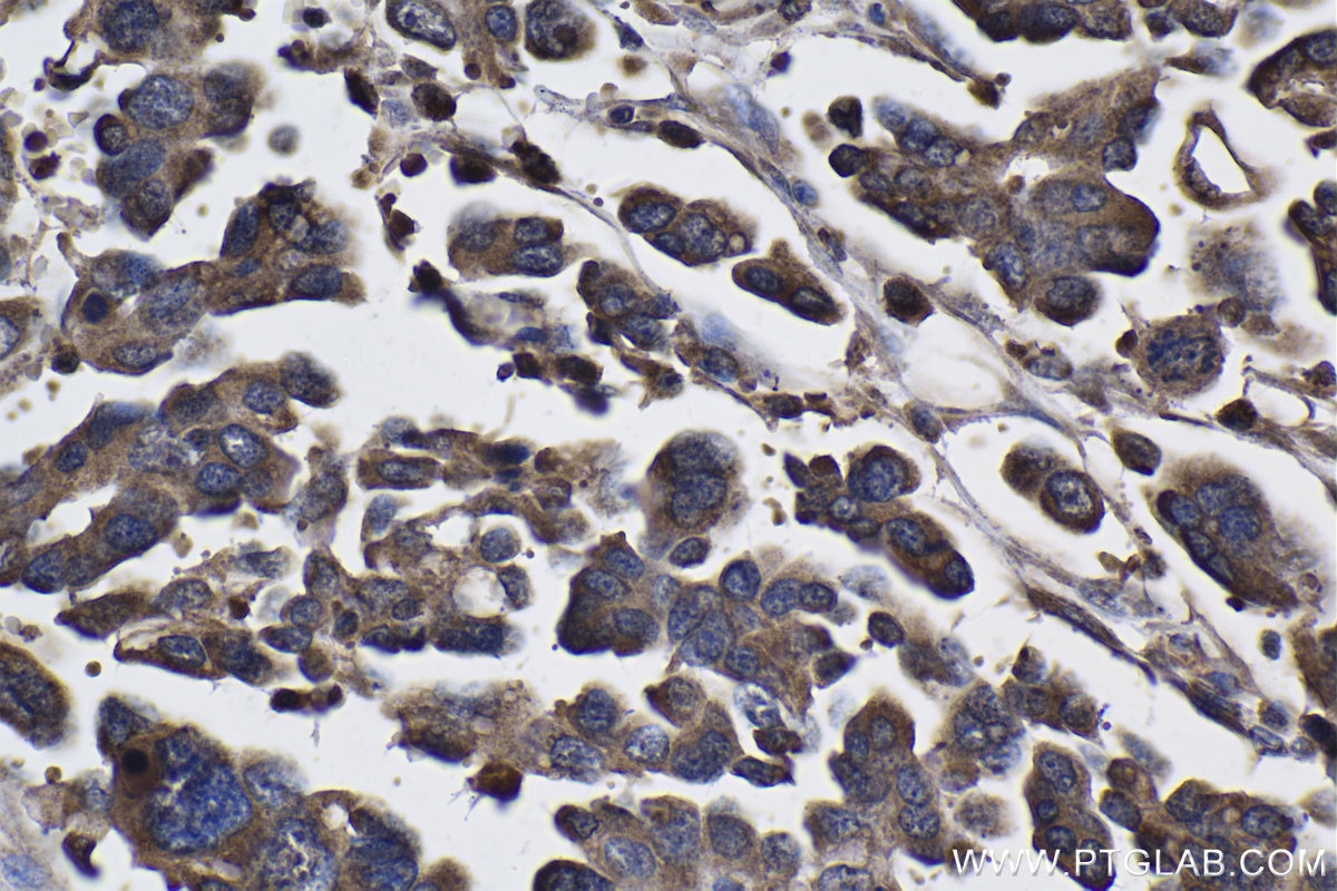 IHC staining of human colon cancer using 19807-1-AP Immunohistochemistry (IHC) staining of human colon cancer tissue using THUMPD3 Polyclonal antibody (19807-1-AP)