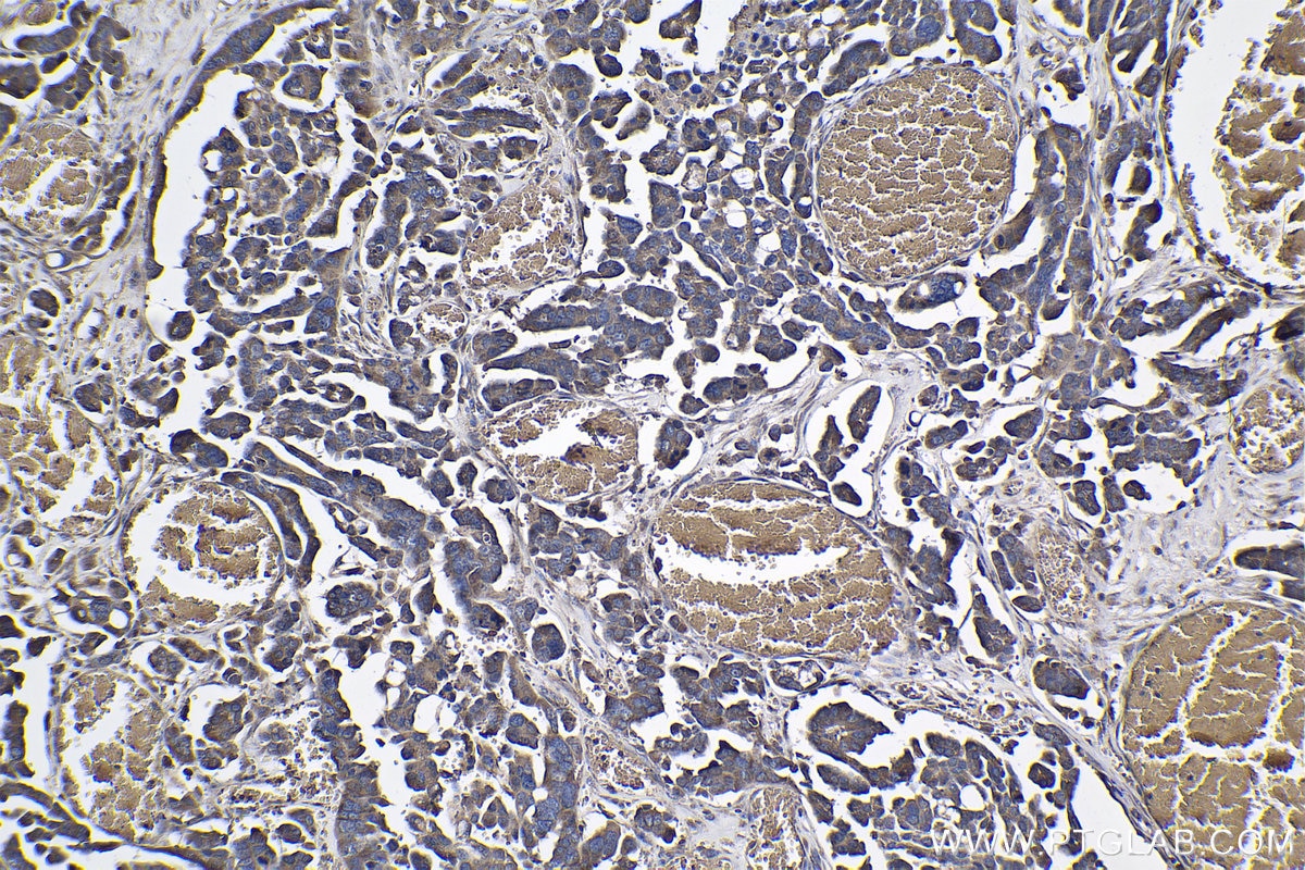 IHC staining of human colon cancer using 19807-1-AP Immunohistochemistry (IHC) staining of human colon cancer tissue using THUMPD3 Polyclonal antibody (19807-1-AP)