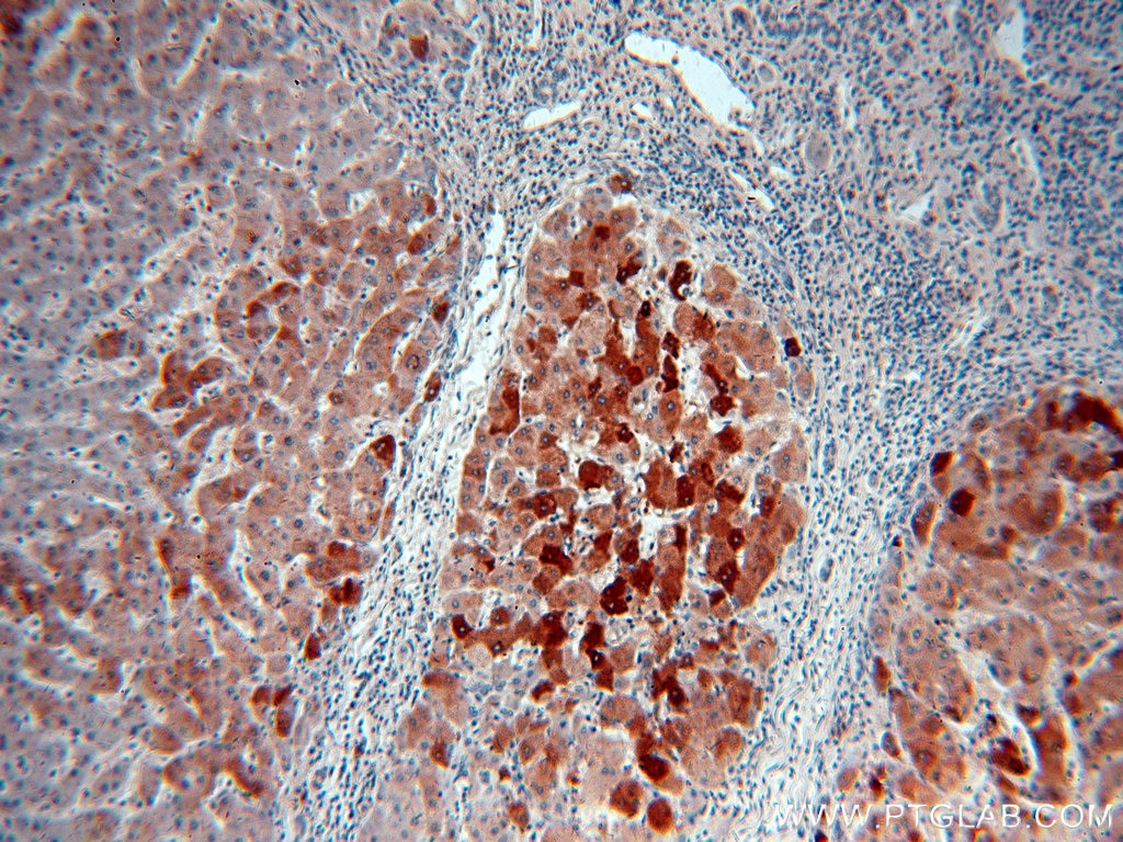 Immunohistochemistry (IHC) staining of human hepatocirrhosis tissue using THUMPD3 Polyclonal antibody (19807-1-AP)