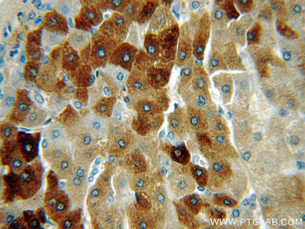 Immunohistochemistry (IHC) staining of human hepatocirrhosis tissue using THUMPD3 Polyclonal antibody (19807-1-AP)