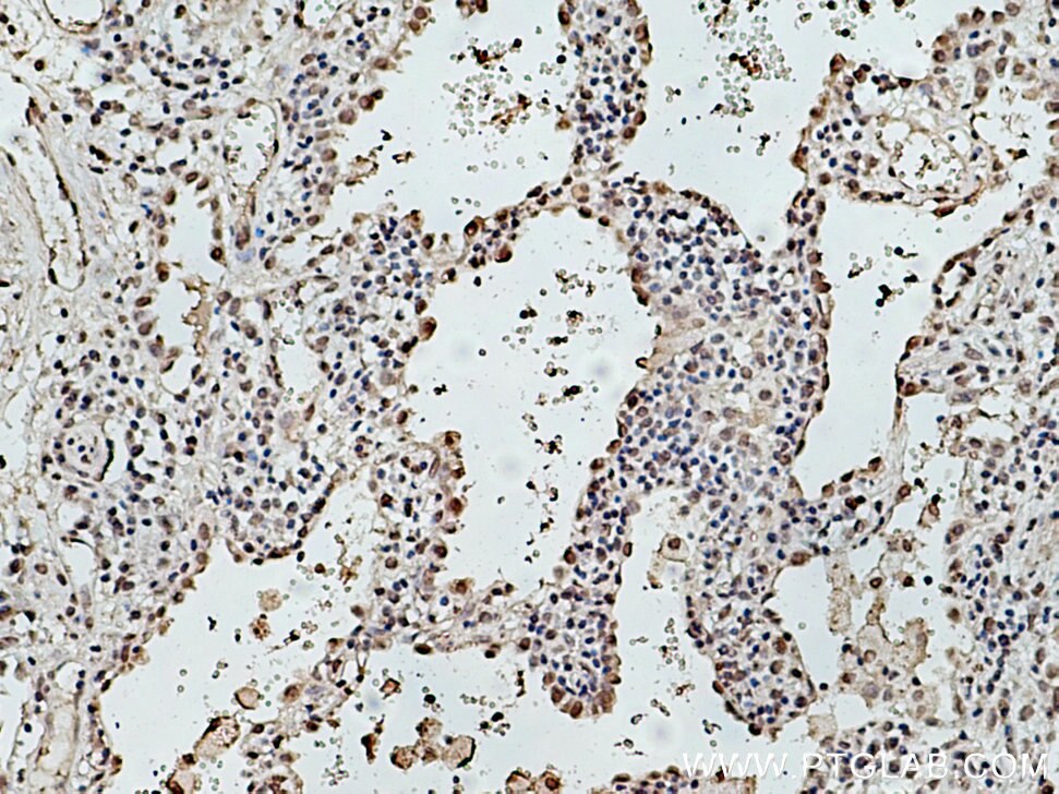 IHC staining of human lung cancer using 15867-1-AP