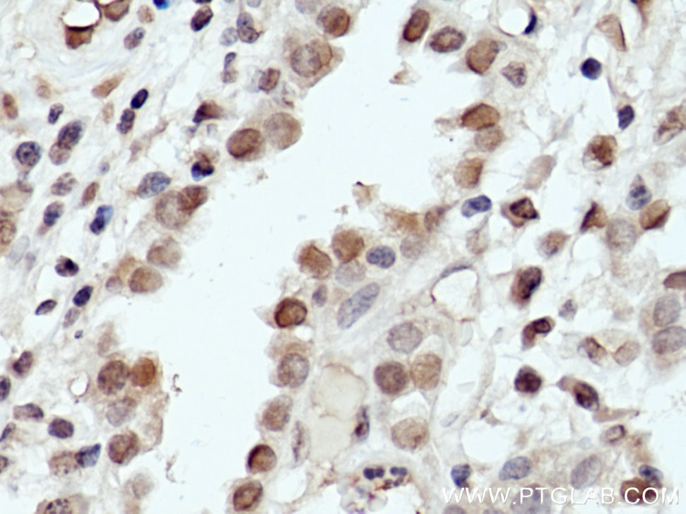 Immunohistochemistry (IHC) staining of human lung cancer tissue using THYN1 Polyclonal antibody (15867-1-AP)