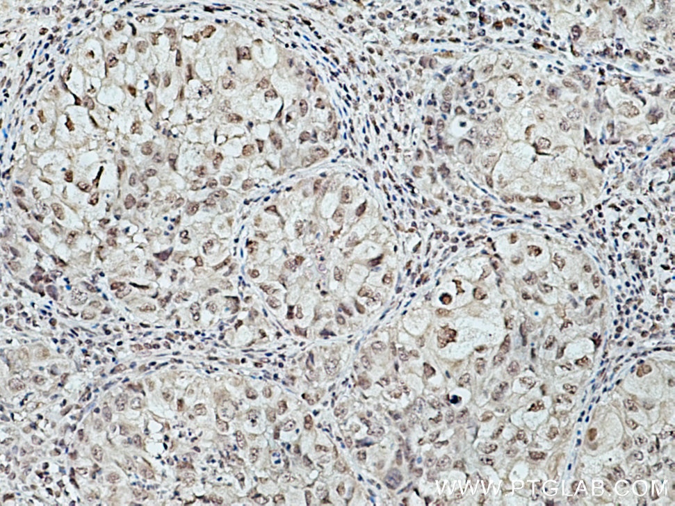 Immunohistochemistry (IHC) staining of human lung cancer tissue using THYN1 Polyclonal antibody (15867-1-AP)