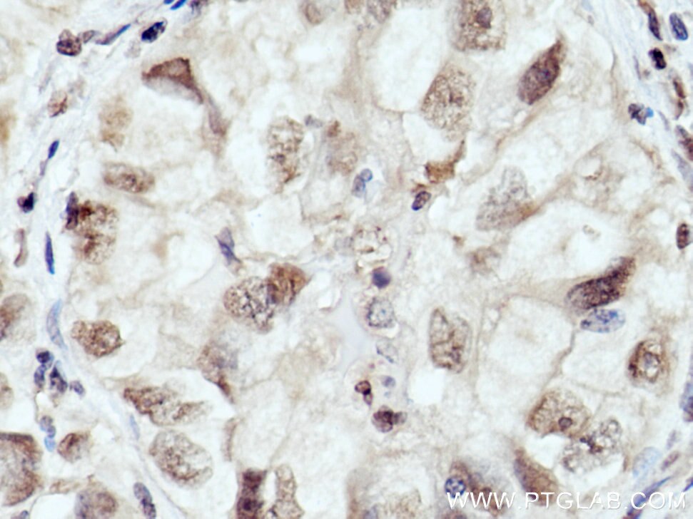 Immunohistochemistry (IHC) staining of human lung cancer tissue using THYN1 Polyclonal antibody (15867-1-AP)