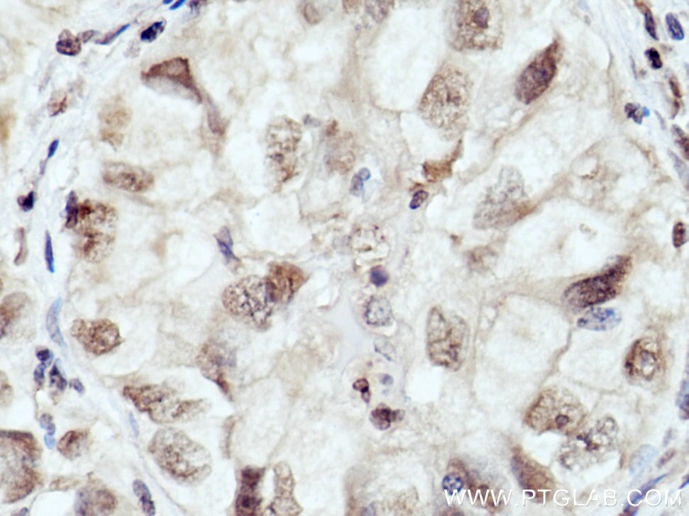 Immunohistochemistry (IHC) staining of human lung cancer tissue using THYN1 Polyclonal antibody (15867-1-AP)