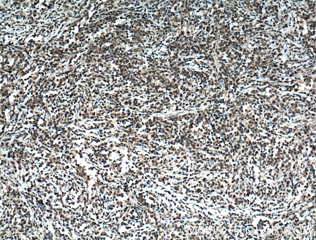 Immunohistochemistry (IHC) staining of human lymphoma tissue using TIA1 Polyclonal antibody (12133-2-AP)