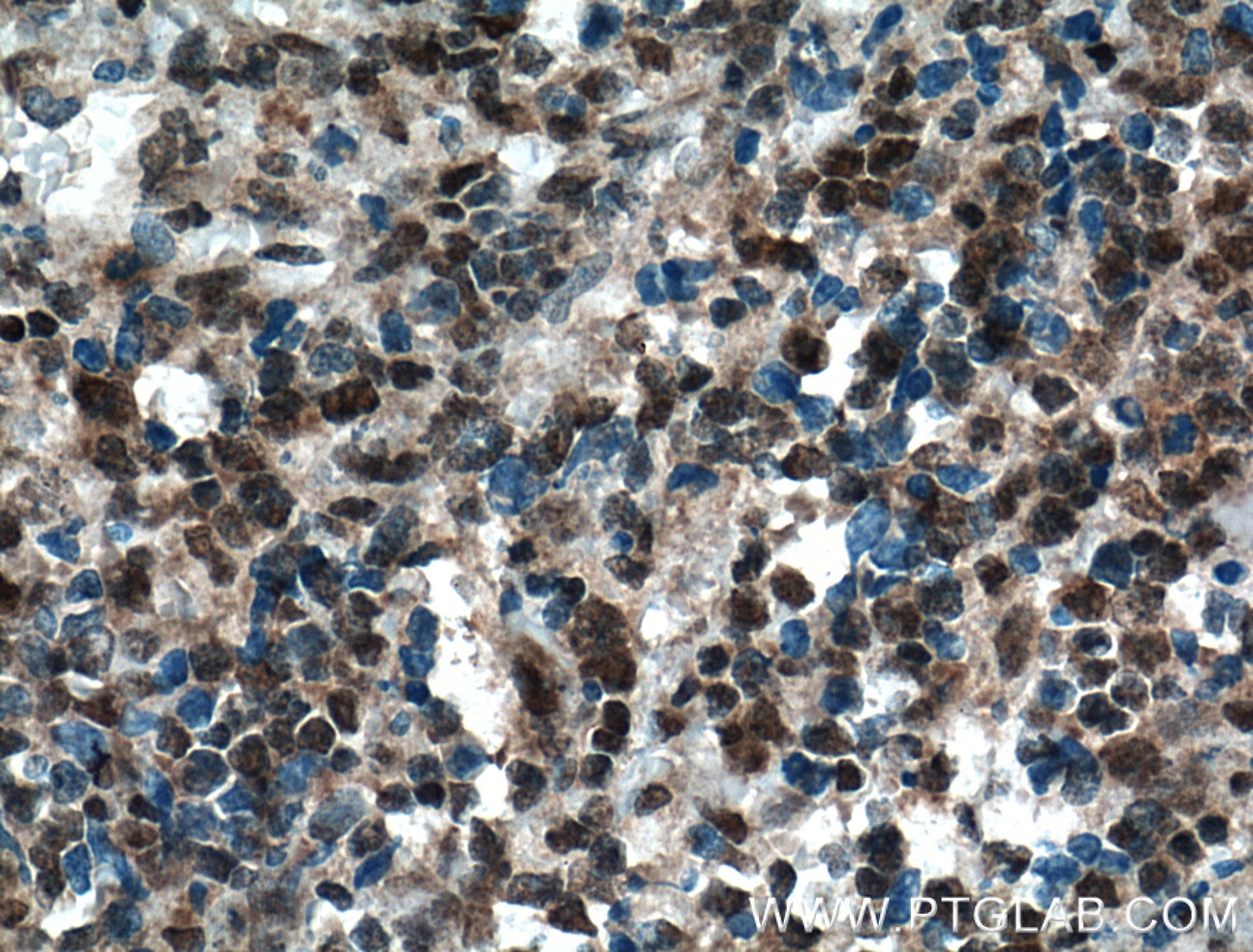 Immunohistochemistry (IHC) staining of human lymphoma tissue using TIA1 Polyclonal antibody (12133-2-AP)