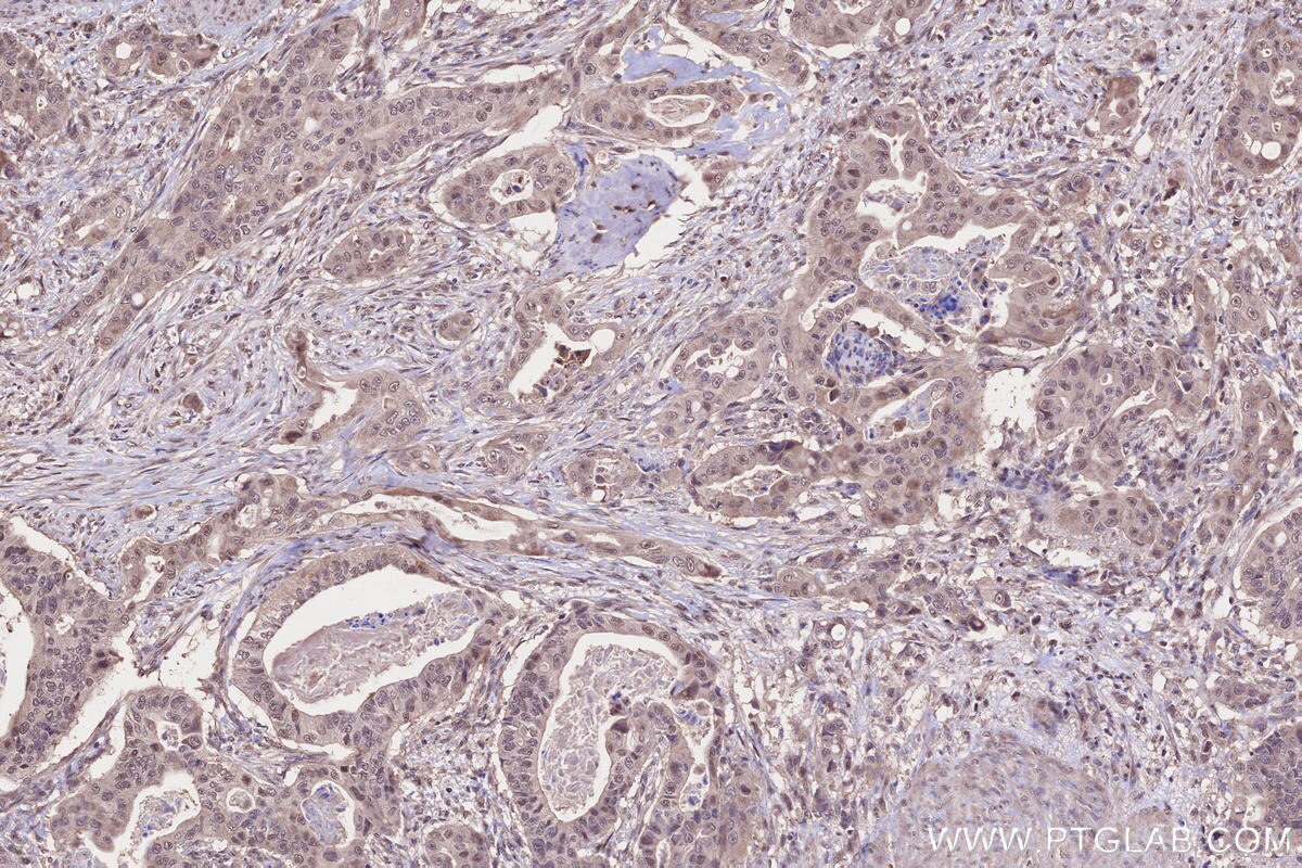 Immunohistochemistry (IHC) staining of human stomach cancer tissue using TIAM2 Polyclonal antibody (26870-1-AP)