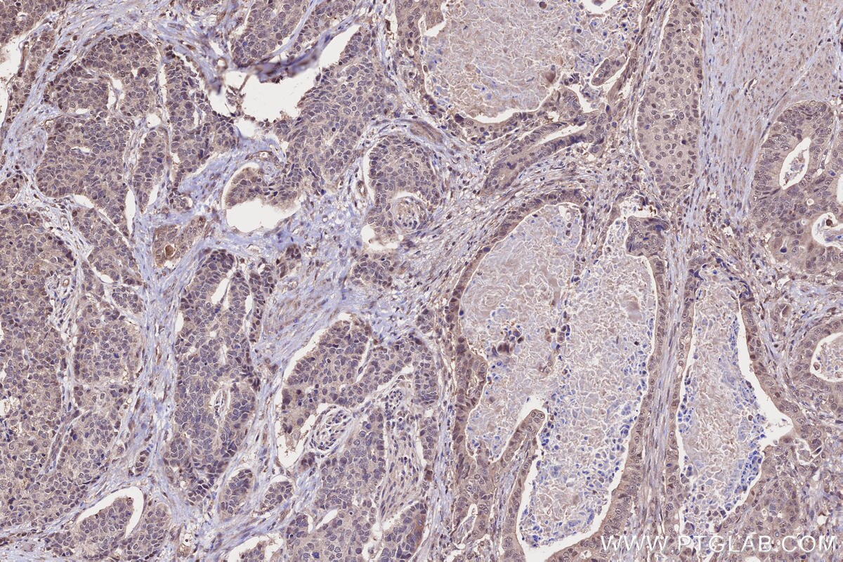 Immunohistochemistry (IHC) staining of human stomach cancer tissue using TIAM2 Polyclonal antibody (26870-1-AP)