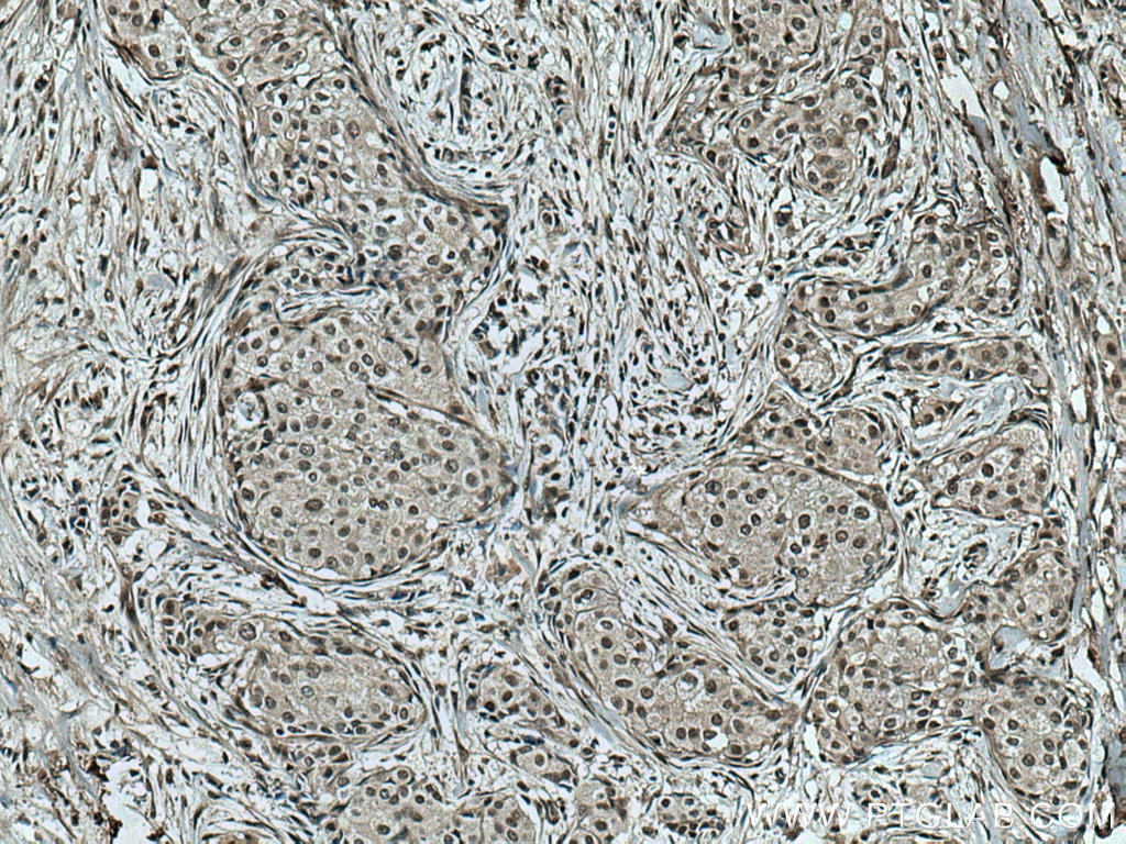 Immunohistochemistry (IHC) staining of human breast cancer tissue using TIAR Monoclonal antibody (66907-1-Ig)