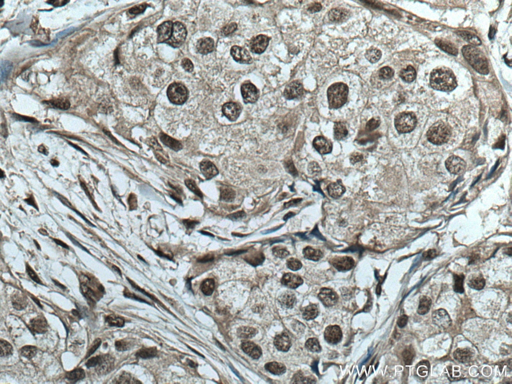 Immunohistochemistry (IHC) staining of human breast cancer tissue using TIAR Monoclonal antibody (66907-1-Ig)