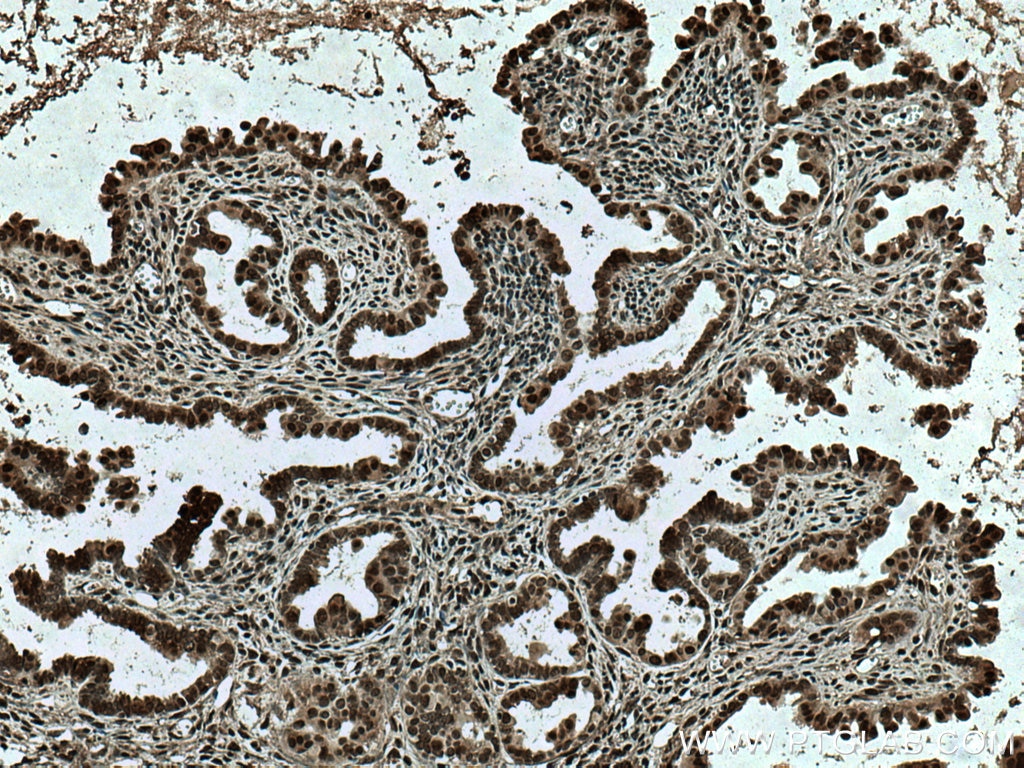 Immunohistochemistry (IHC) staining of human ovary tumor tissue using TIAR Monoclonal antibody (66907-1-Ig)