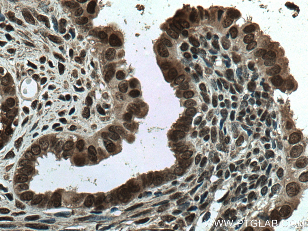 Immunohistochemistry (IHC) staining of human ovary tumor tissue using TIAR Monoclonal antibody (66907-1-Ig)