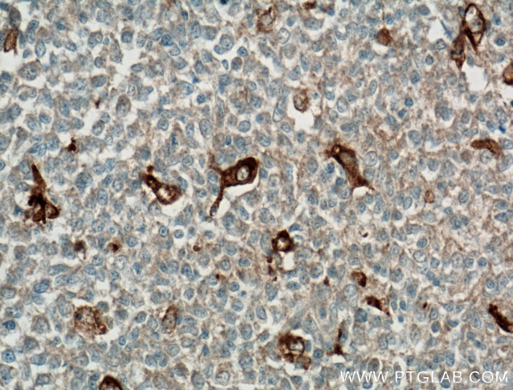 Immunohistochemistry (IHC) staining of human tonsillitis tissue using TIMD4 Polyclonal antibody (12008-1-AP)