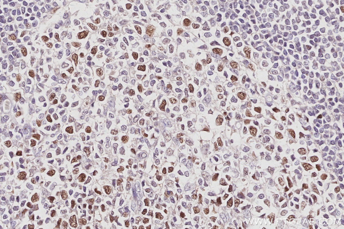 Immunohistochemistry (IHC) staining of human appendicitis tissue using TIMELESS Polyclonal antibody (14421-1-AP)