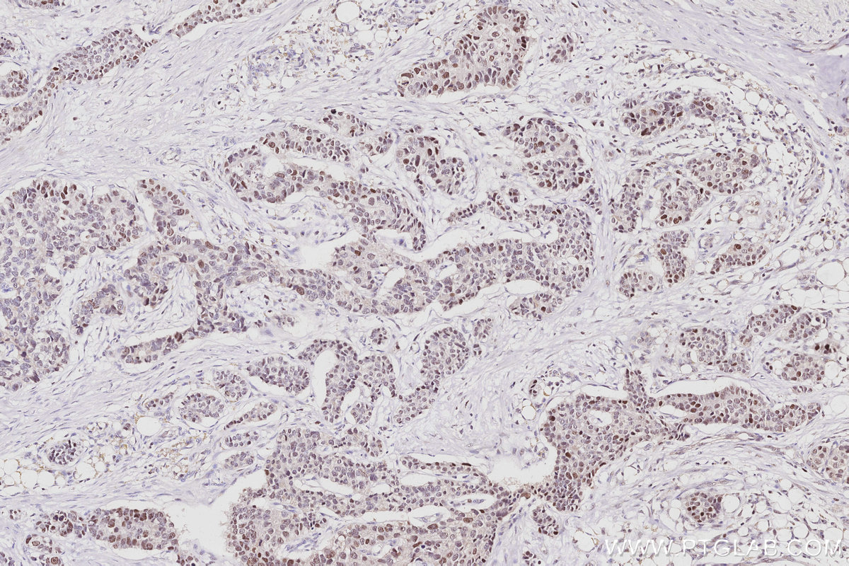 Immunohistochemistry (IHC) staining of human stomach cancer tissue using TIMELESS Polyclonal antibody (14421-1-AP)