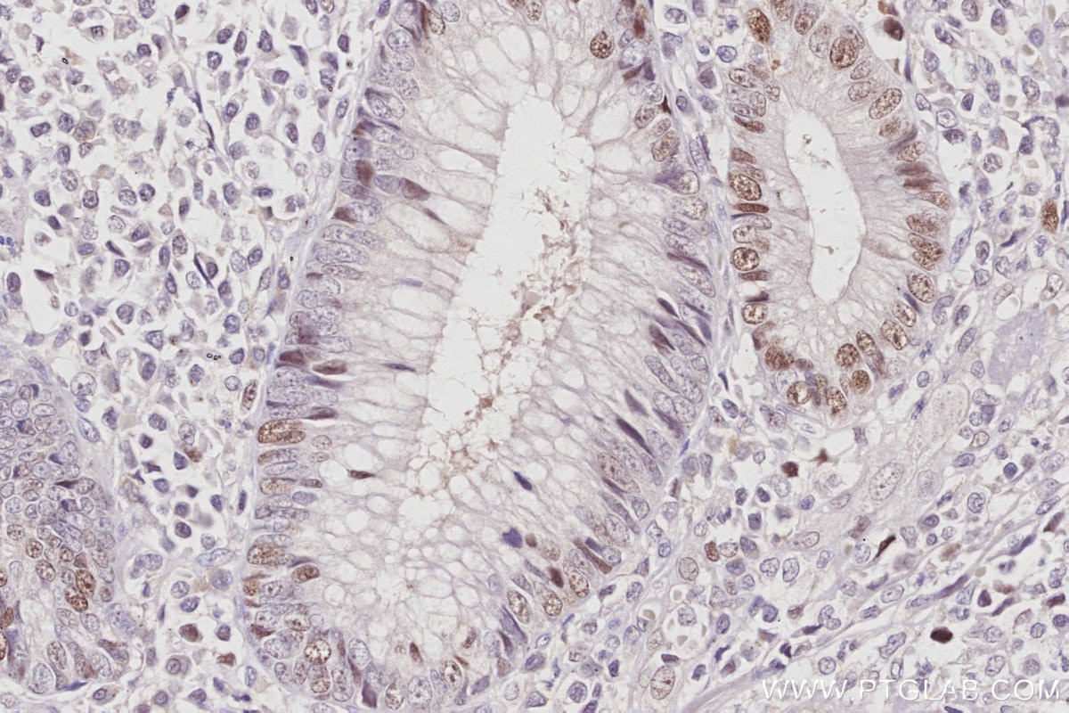 Immunohistochemistry (IHC) staining of human appendicitis tissue using TIMELESS Polyclonal antibody (14421-1-AP)