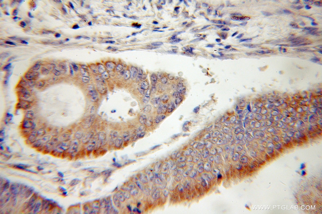 IHC staining of human colon cancer using 11124-2-AP