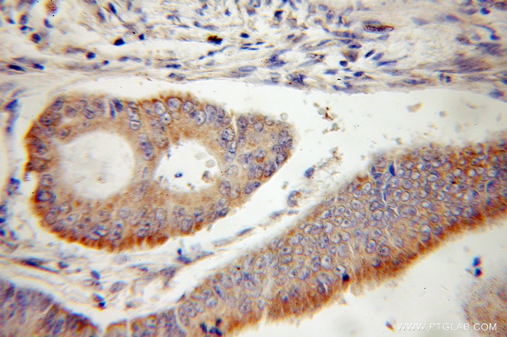 Immunohistochemistry (IHC) staining of human colon cancer tissue using TIMM10 Polyclonal antibody (11124-2-AP)