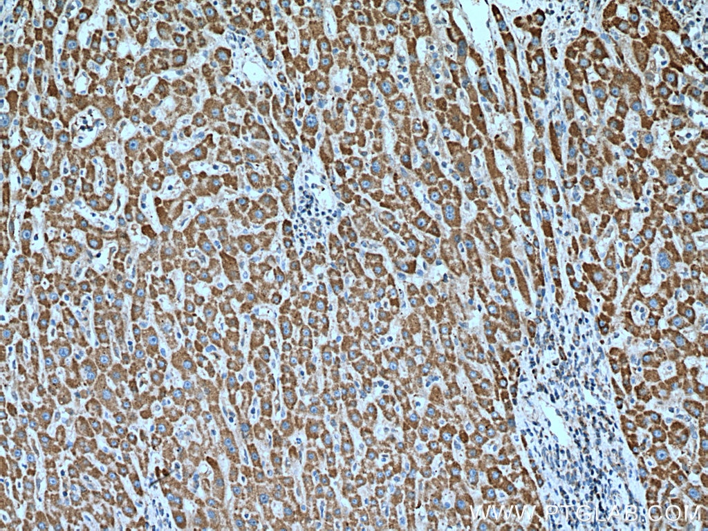 Immunohistochemistry (IHC) staining of human liver cancer tissue using TIMM13 Polyclonal antibody (11973-1-AP)