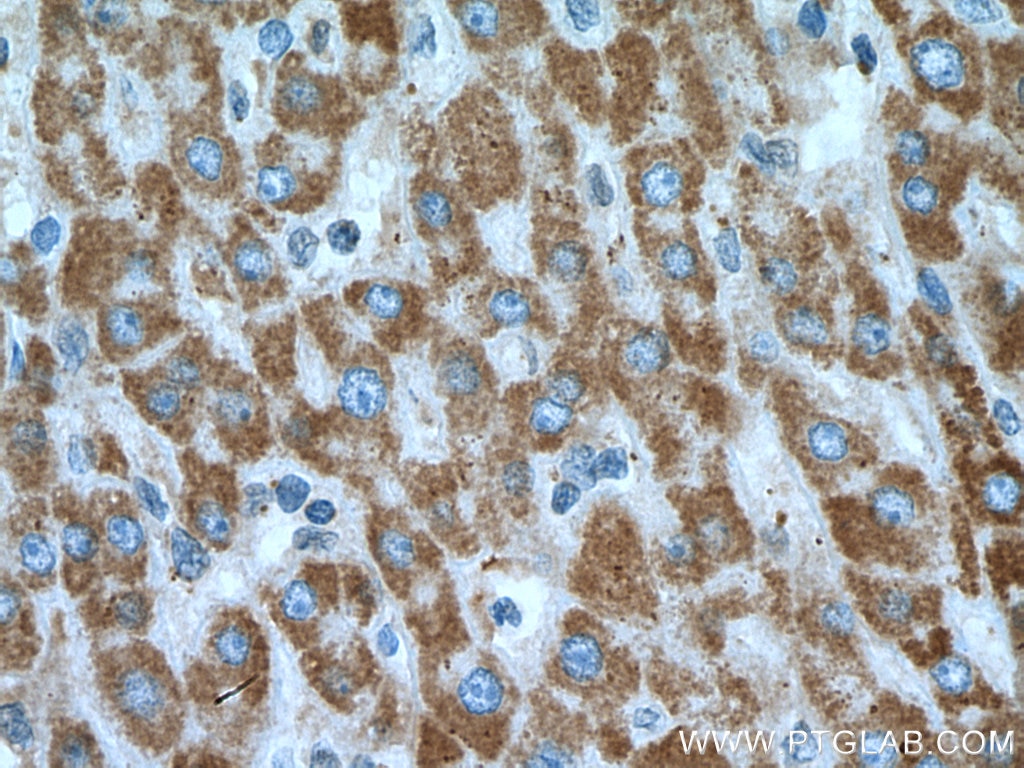 Immunohistochemistry (IHC) staining of human liver cancer tissue using TIMM13 Polyclonal antibody (11973-1-AP)