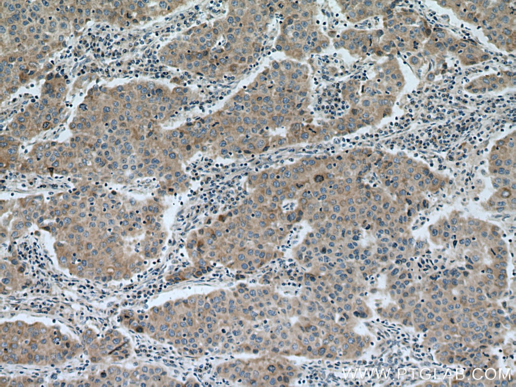 Immunohistochemistry (IHC) staining of human breast cancer tissue using TIMM17A Polyclonal antibody (11189-1-AP)