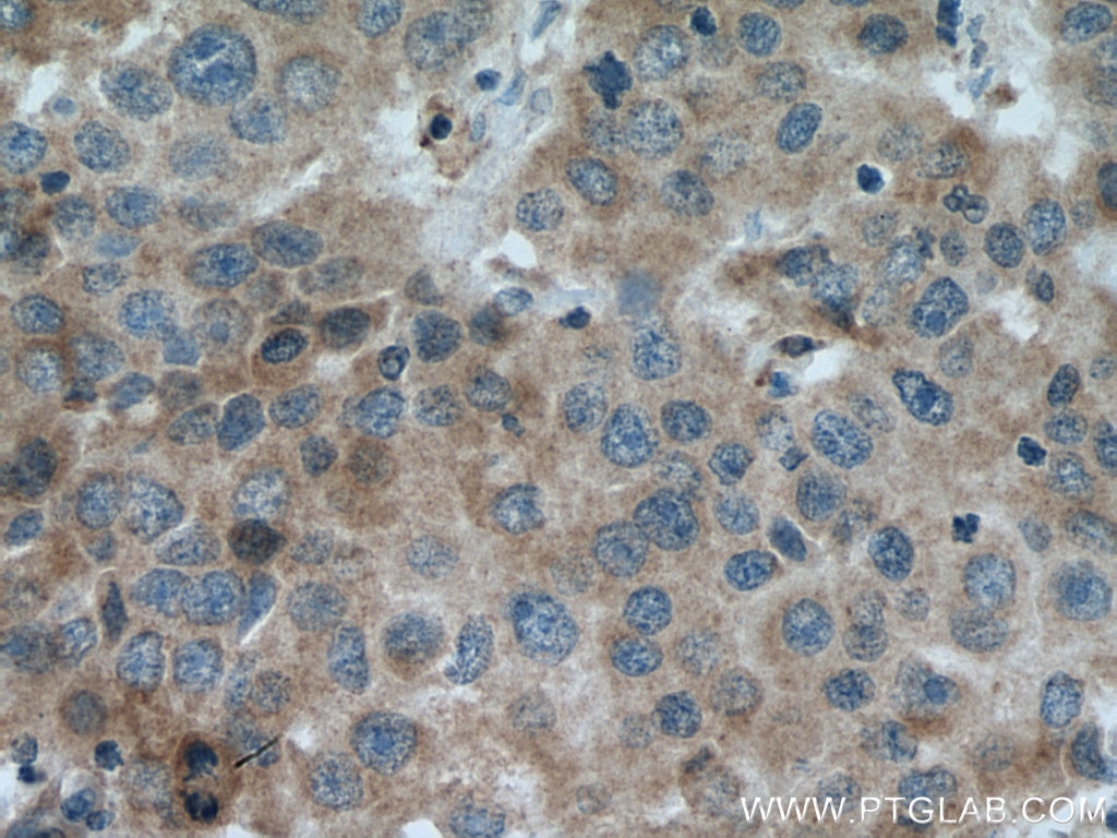 Immunohistochemistry (IHC) staining of human breast cancer tissue using TIMM17A Polyclonal antibody (11189-1-AP)