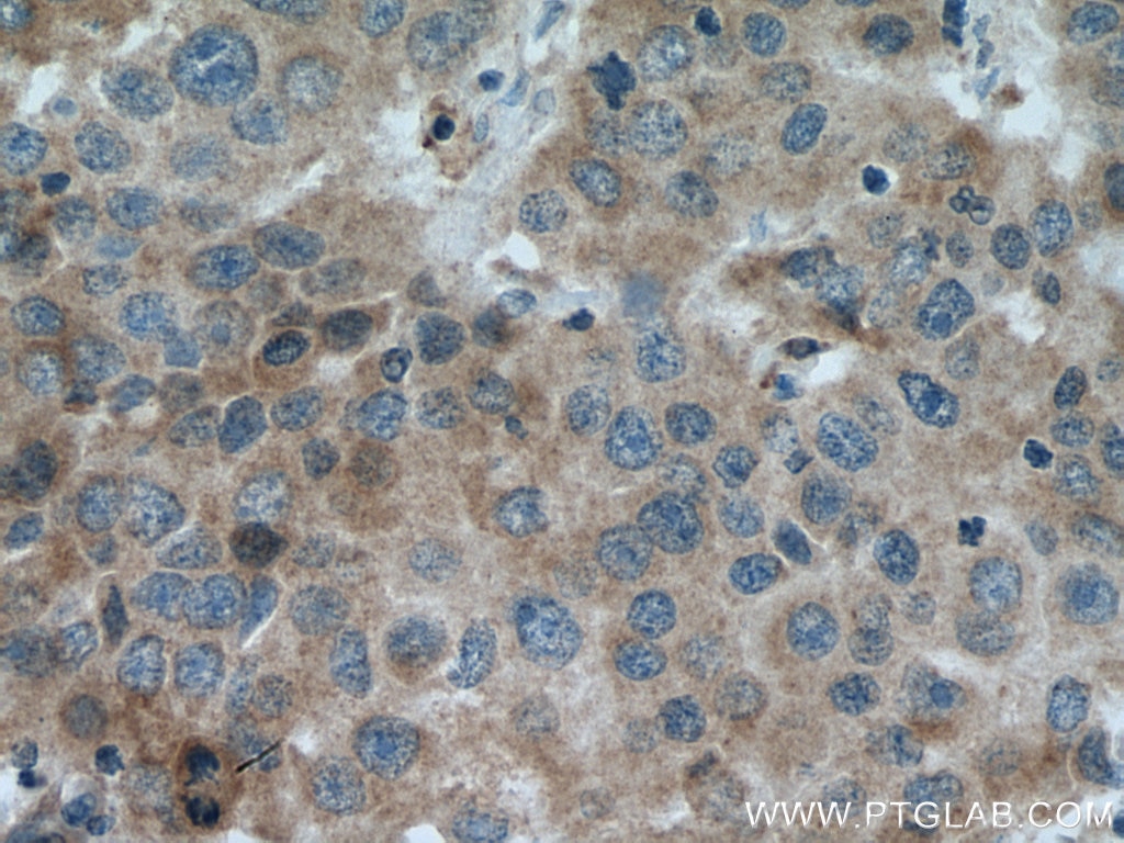 IHC staining of human breast cancer using 11189-1-AP