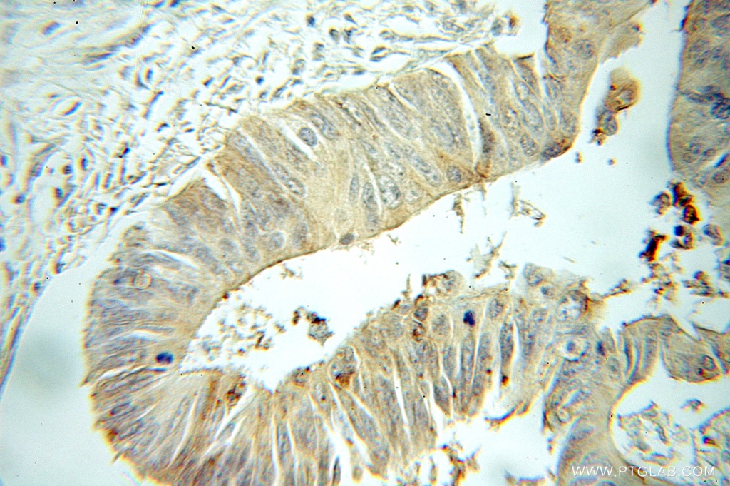 Immunohistochemistry (IHC) staining of human colon cancer tissue using TIMM17B Polyclonal antibody (11062-1-AP)