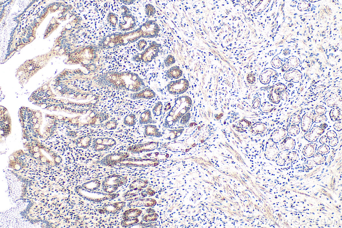 Immunohistochemistry (IHC) staining of human stomach cancer tissue using TIMM9 Polyclonal antibody (11479-1-AP)