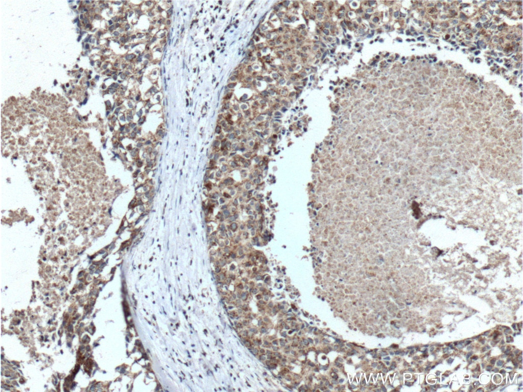 IHC staining of human breast cancer using 10753-1-AP