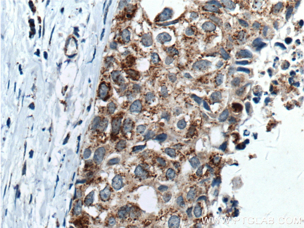 Immunohistochemistry (IHC) staining of human breast cancer tissue using TIMP1 Polyclonal antibody (10753-1-AP)