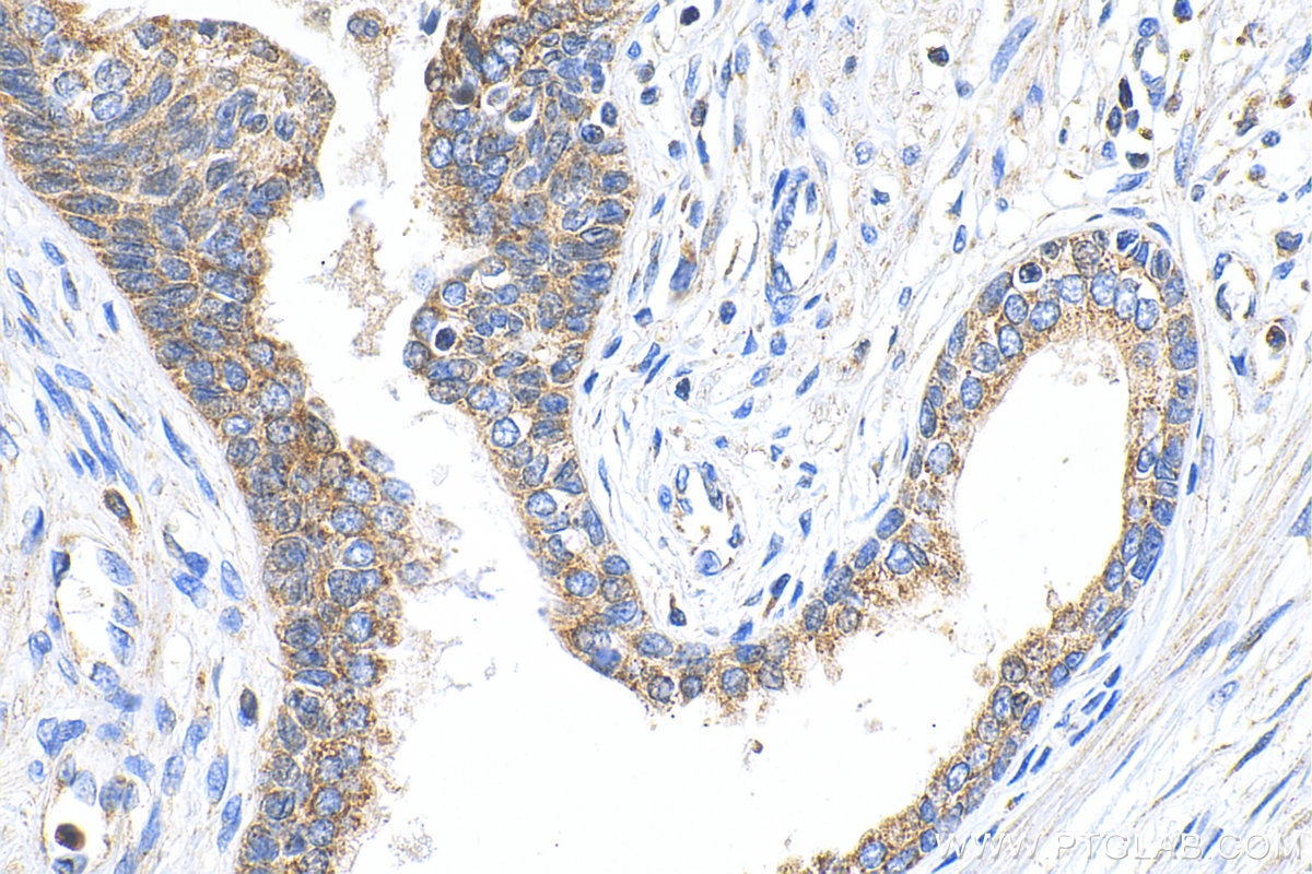 Immunohistochemistry (IHC) staining of human prostate cancer tissue using TIMP-2 Polyclonal antibody (17353-1-AP)
