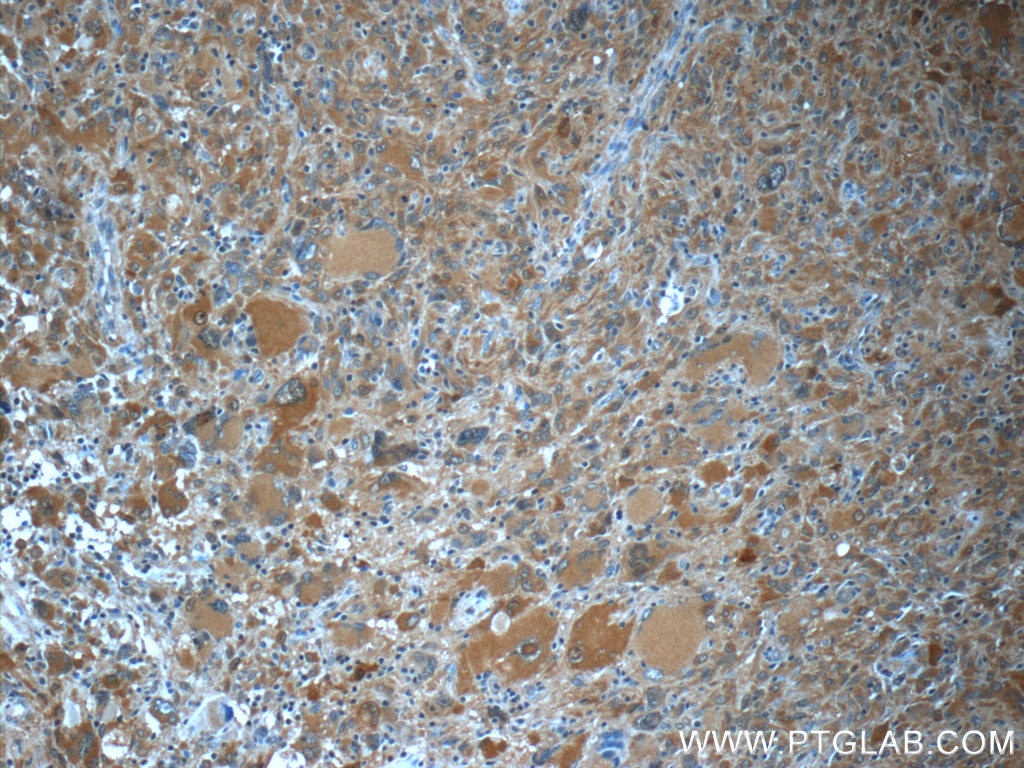 Immunohistochemistry (IHC) staining of human gliomas tissue using TIMP-4 Polyclonal antibody (12326-1-AP)