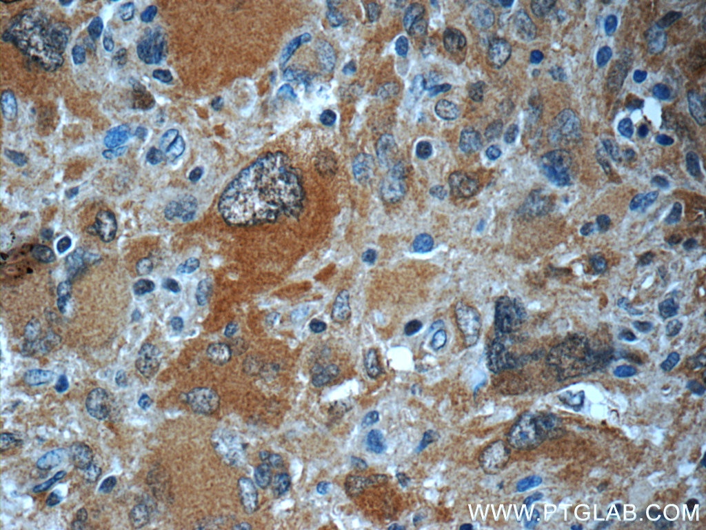 Immunohistochemistry (IHC) staining of human gliomas tissue using TIMP-4 Polyclonal antibody (12326-1-AP)