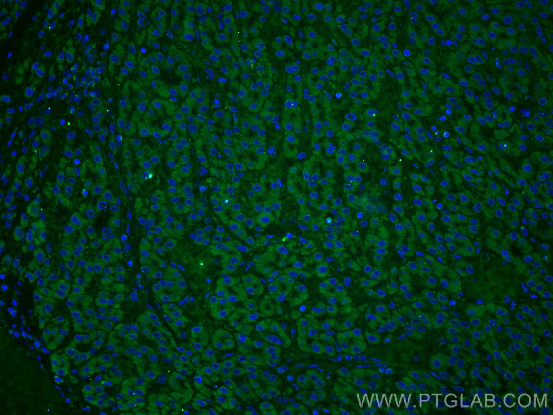 Immunofluorescence (IF) / fluorescent staining of human liver cancer tissue using TINAGL1 Polyclonal antibody (12077-1-AP)