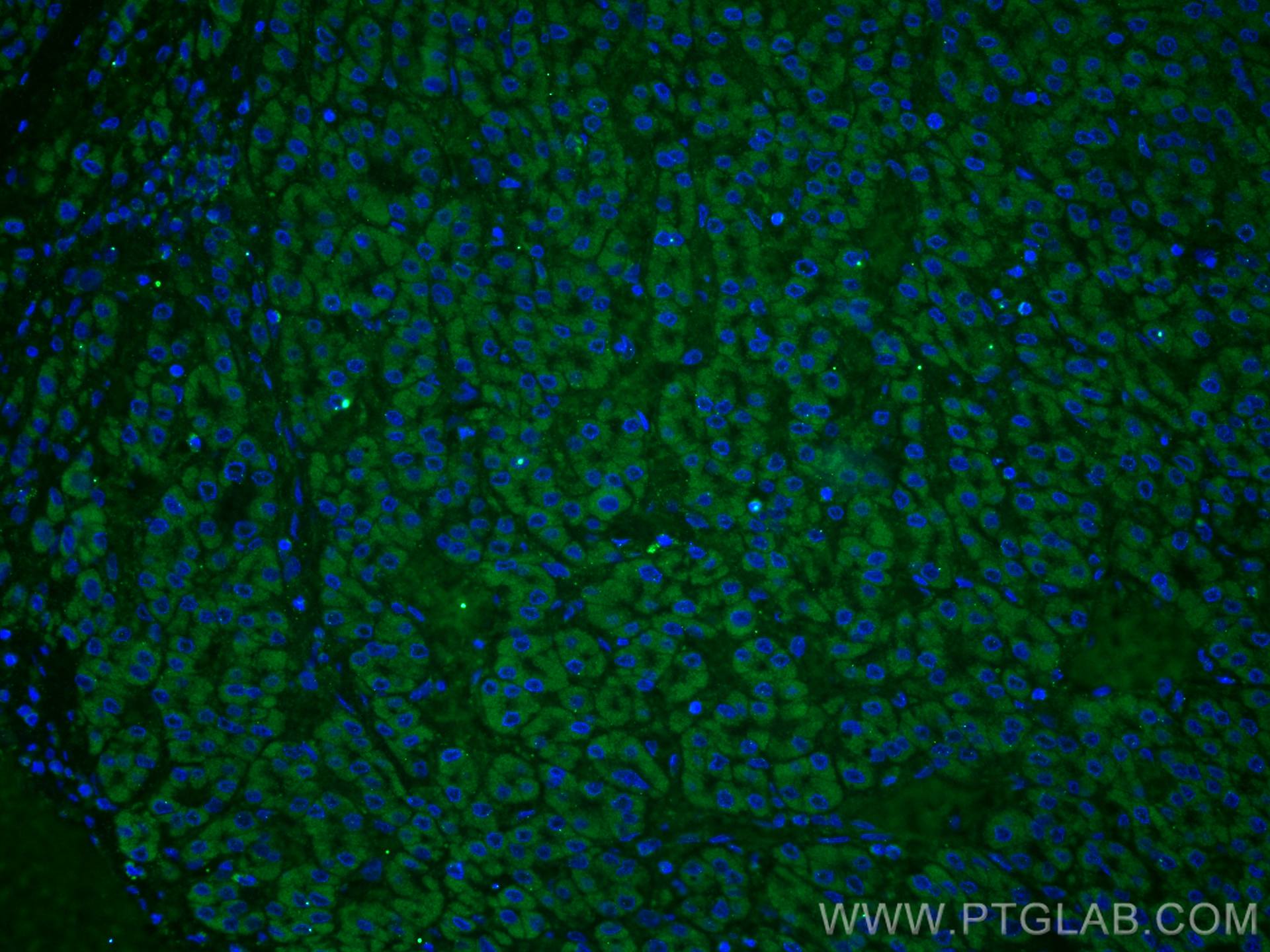 Immunofluorescence (IF) / fluorescent staining of human liver cancer tissue using TINAGL1 Polyclonal antibody (12077-1-AP)