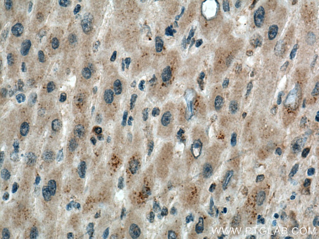 Immunohistochemistry (IHC) staining of human liver cancer tissue using TINAGL1 Polyclonal antibody (12077-1-AP)