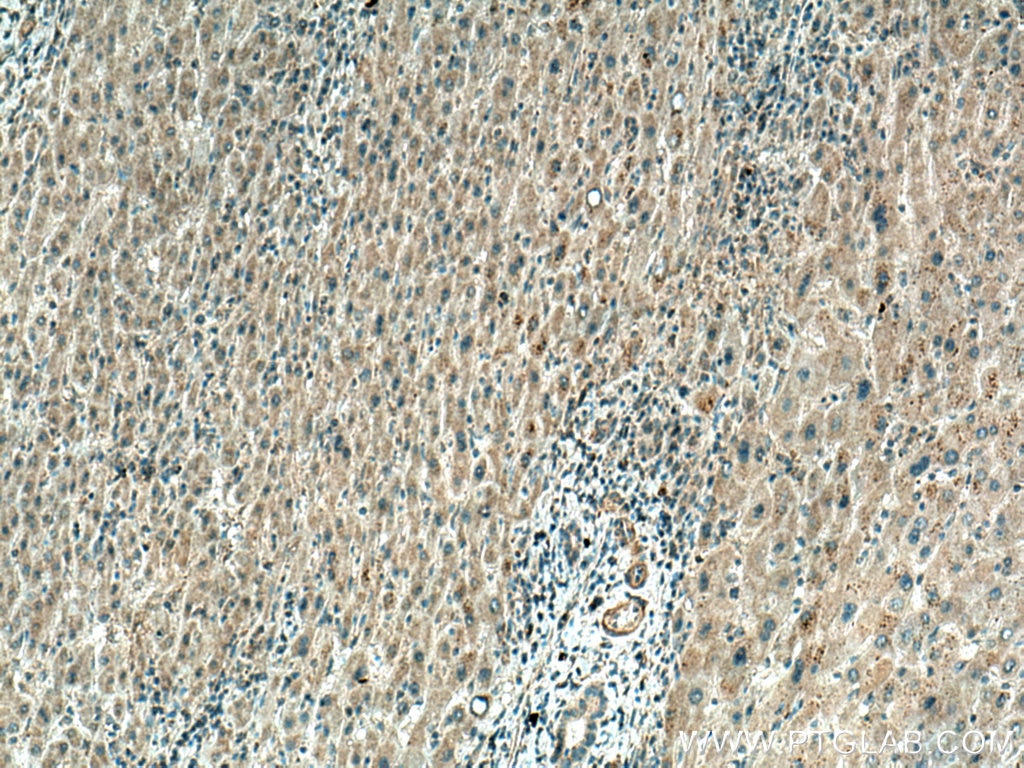 Immunohistochemistry (IHC) staining of human liver cancer tissue using TINAGL1 Polyclonal antibody (12077-1-AP)