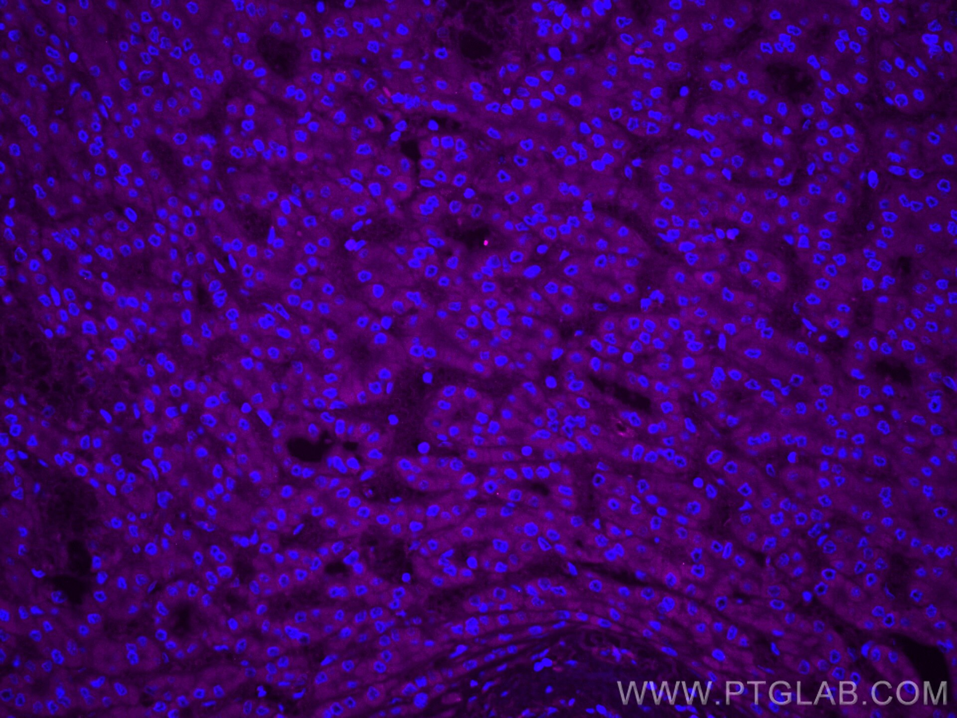 IF Staining of human liver cancer using CL647-12077