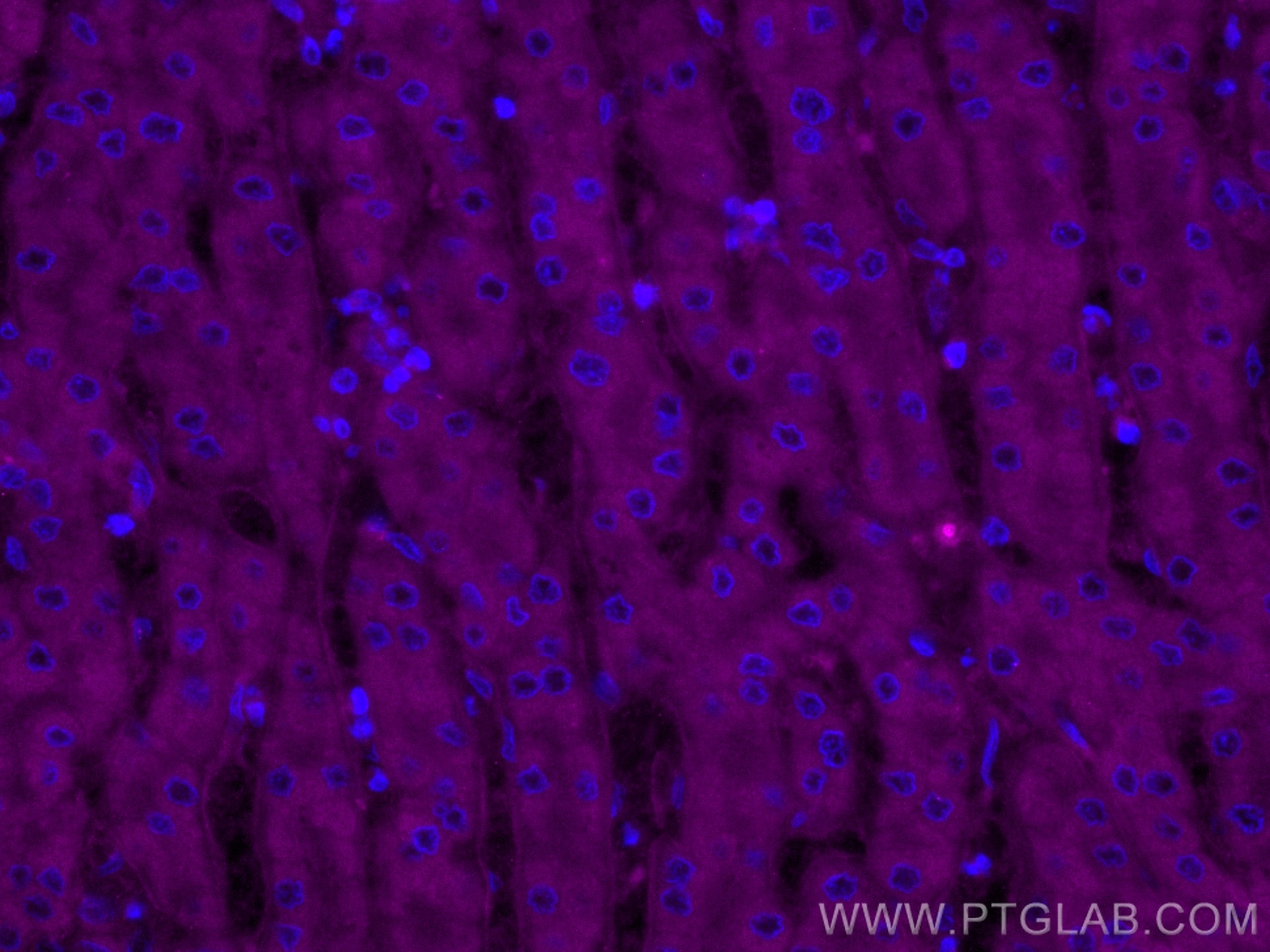 Immunofluorescence (IF) / fluorescent staining of human liver cancer tissue using CoraLite® Plus 647-conjugated TINAGL1 Polyclonal a (CL647-12077)