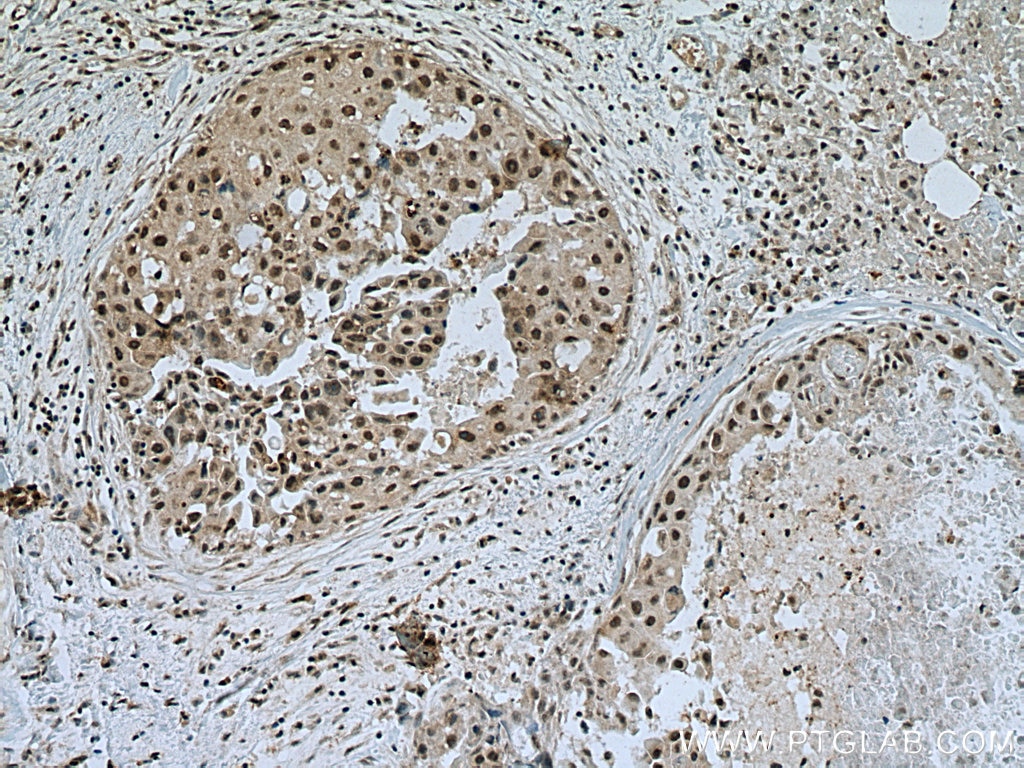 IHC staining of human breast cancer using 16230-1-AP