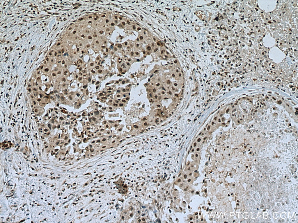 Immunohistochemistry (IHC) staining of human breast cancer tissue using TINP1 Polyclonal antibody (16230-1-AP)