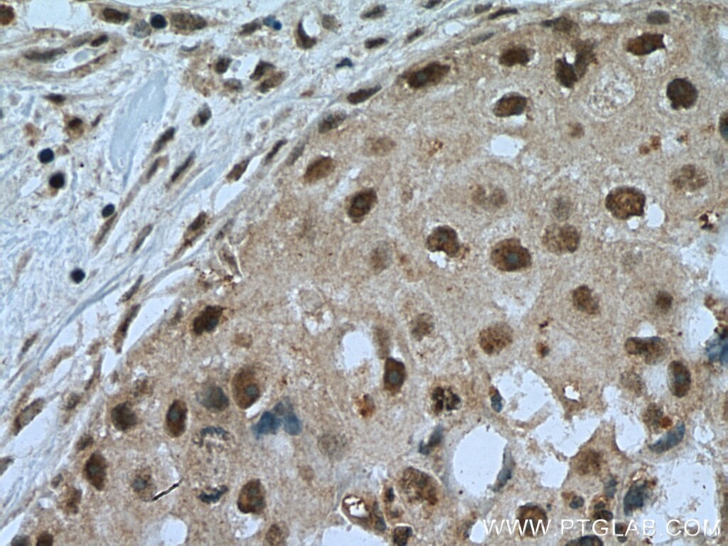 Immunohistochemistry (IHC) staining of human breast cancer tissue using TINP1 Polyclonal antibody (16230-1-AP)