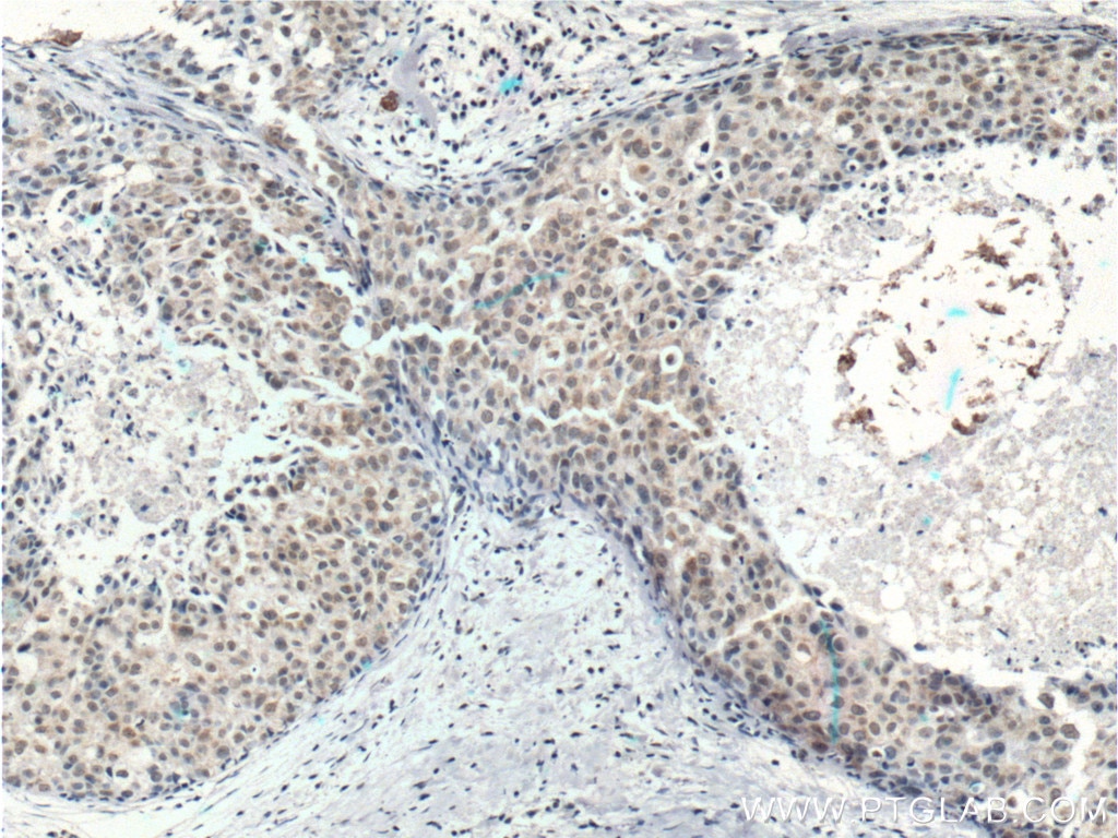 IHC staining of human breast cancer using 66374-1-Ig