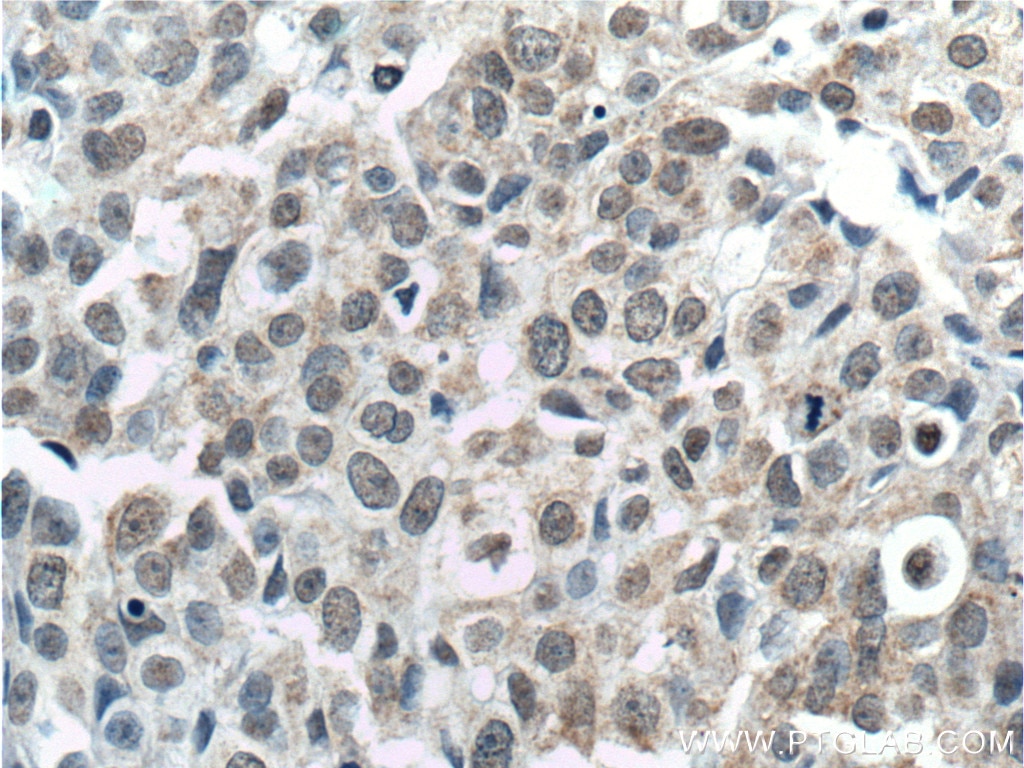 Immunohistochemistry (IHC) staining of human breast cancer tissue using TINP1 Monoclonal antibody (66374-1-Ig)