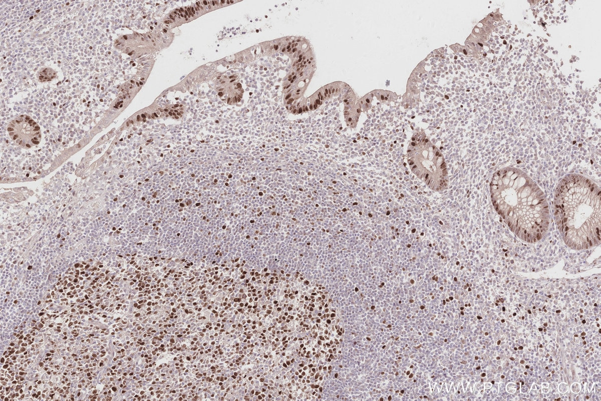 Immunohistochemistry (IHC) staining of human appendicitis tissue using TIPIN Polyclonal antibody (11972-2-AP)