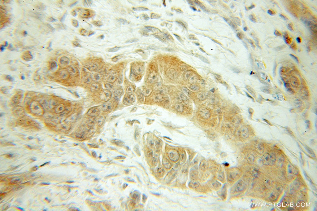Immunohistochemistry (IHC) staining of human pancreas cancer tissue using TIRAP Polyclonal antibody (10497-1-AP)