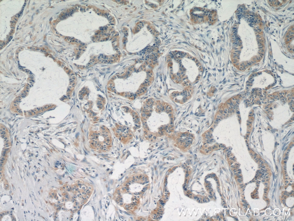 IHC staining of human breast cancer using 15691-1-AP