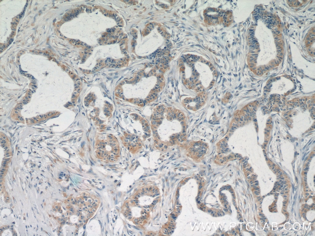 Immunohistochemistry (IHC) staining of human breast cancer tissue using TK1 Polyclonal antibody (15691-1-AP)